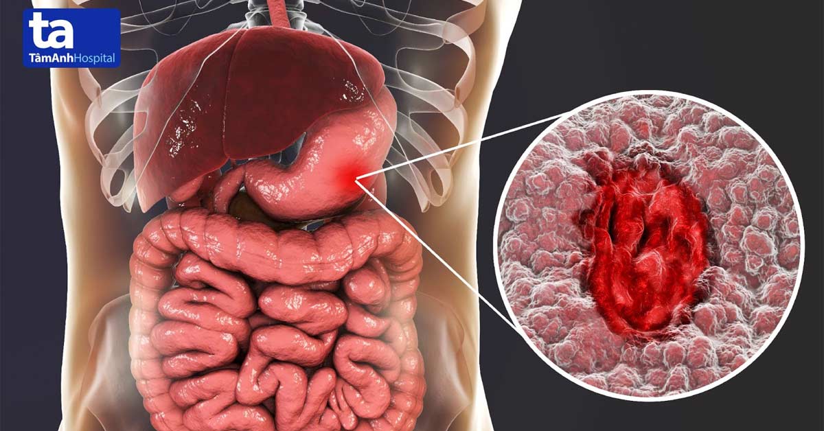 Ung thư dạ dày – Nguyên nhân, triệu chứng và phương pháp điều trị